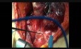 Monitorización intraoperatoria del nervio laríngeo recurrente durante la tiroidectomía mediante NIM-Response 3.0
