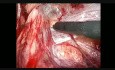 Reparación laparoscópica de hernia inguinal - paso 4 - preparación del lado derecho