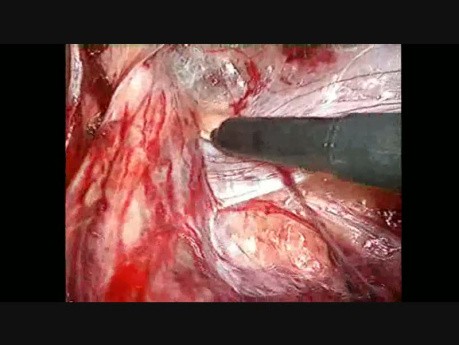 Reparación laparoscópica de hernia inguinal - paso 4 - preparación del lado derecho