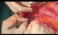 Paciente con aneurisma del tracto de salida del ventrículo derecho (TSVD) sometido a operación de Florida por aneurisma pulmonar