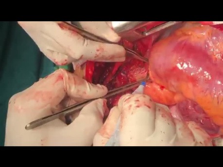 Paciente con aneurisma del tracto de salida del ventrículo derecho (TSVD) sometido a operación de Florida por aneurisma pulmonar
