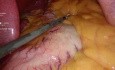 Gastrectomía en manga laparoscópica