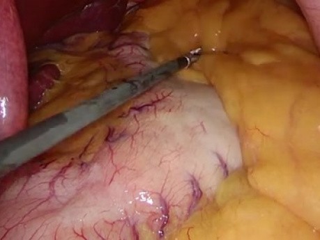Gastrectomía en manga laparoscópica