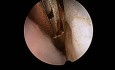 Histeroscopia de oficina - mioma submucoso