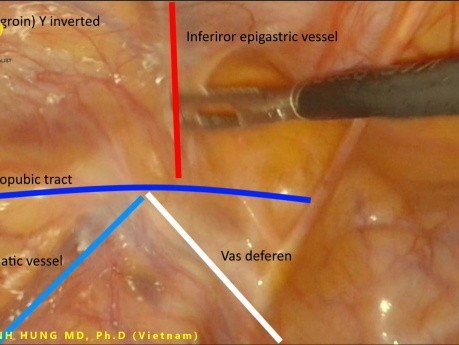 Nuevo concepto anatómico para la reparación de la hernia inguinal por laparoscopia
