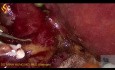 Colecistectomía laparoscópica