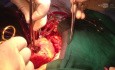 Demostración de VSD anterior