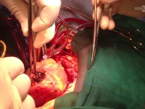 Cardiac operations