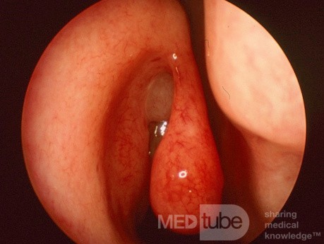 Pólipo nasal sentinal {derecha}