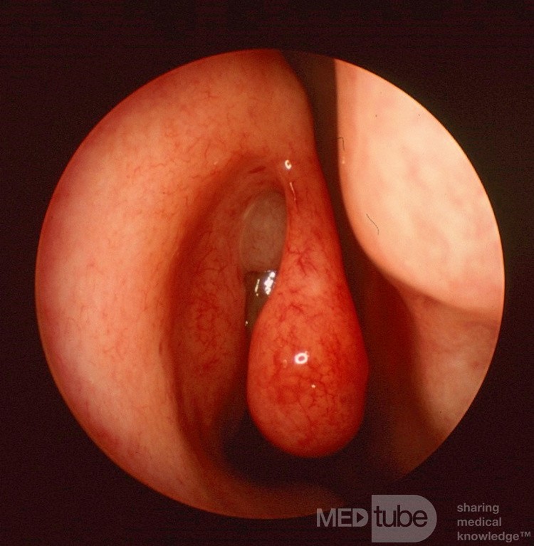 Pólipo nasal sentinal {derecha}