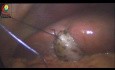 La vesícula biliar resistente se puede retraer con suturas