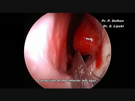 Septoplastia endoscópica: pequeño espolón inferior