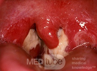 Mononucleosis infecciosa