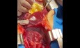 Extracción de corazón pediátrico usando la cardioplejía retrógrada