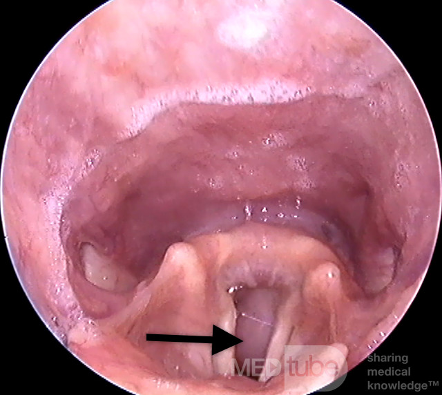 Tumor subglótico