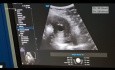 Ablación por microondas guiada por laparoscopia y ultrasonido de la adenomiosis 