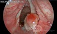 Granuloma piógeno del aritenoide