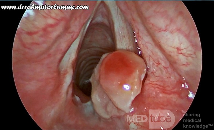 Granuloma piógeno del aritenoide