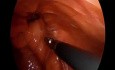 Hernia bilateral