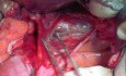 Anatomía del útero - 3 planos avasculares posteriores y su importancia en la histerectomía radical