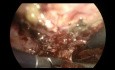 Fístula Prostato-Sinfisaria. Corrección Laparoscópica Extraperitoneal.