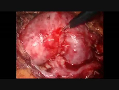 Pielolitotomía laparoscópica en riñón en herradura