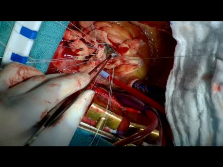 Sustitución de la raíz aórtica con un conducto con válvula mecánica para tratar el aneurisma de la raíz aórtica