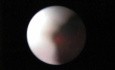 Laser Ureteroscopy - Part 2