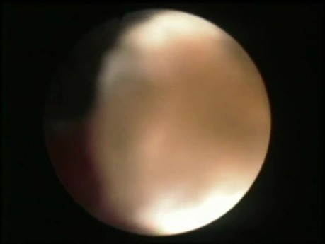 PCNL - Nefroscopio flexible
