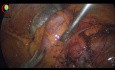 Las lesiones térmicas del intestino deben cubrirse con suturas seromusculares transversales