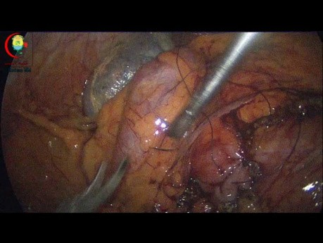 Las lesiones térmicas del intestino deben cubrirse con suturas seromusculares transversales