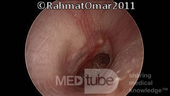 Perforación de la membrana timpánica - fase inactiva