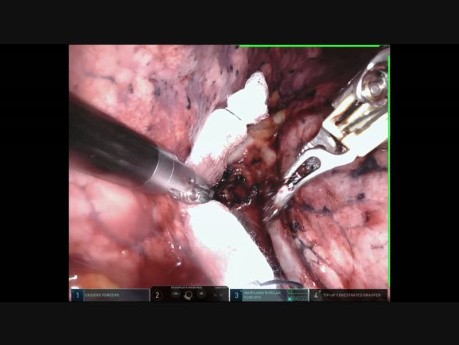 Lobectomia Inferior Esquerda Robotica em Octagenario