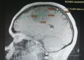 Planificación quirúrgica con neuronavegador en paciente con lesión de masa intracraneal. Glioma de alto grado.