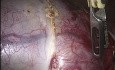 Cistectomía de teratoma enorme