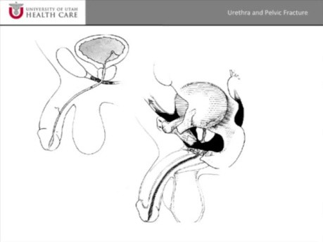 Fractura pélvica Lesiones uretrales