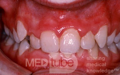 Gingivitis