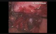 Histerectomía laparoscópica total con ooforectomía de salpingo bilateral en endometriosis