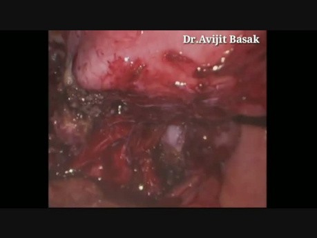 Histerectomía laparoscópica total con ooforectomía de salpingo bilateral en endometriosis