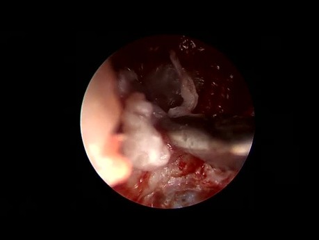 Escisión endoscópica transcanal de colesteatoma