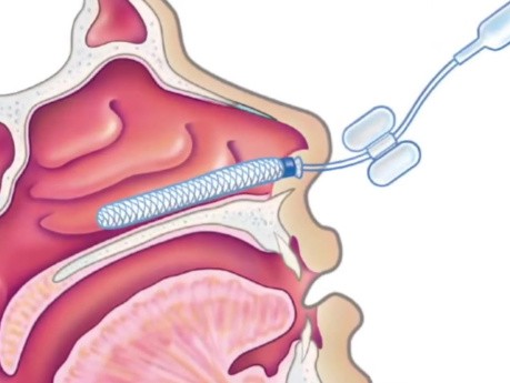 Cauterización nasal y taponamiento nasal Ant-Post
