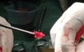 Microdiscectomía Lumbar