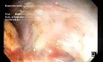 Disección submucosa endoscópica (ESD) de un enorme LST-G de tipo mixto de 11x5 cm en un paciente con síndrome de fragilidad