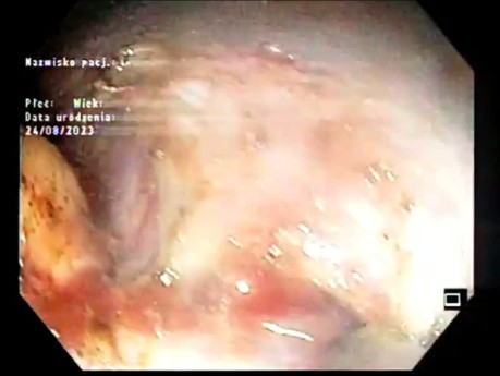 Disección submucosa endoscópica (ESD) de un enorme LST-G de tipo mixto de 11x5 cm en un paciente con síndrome de fragilidad