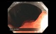 Canal de colonoscopia - resección de un pólipo de colon gigante