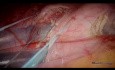 Resección laparoscópica de dos tumores gástricos