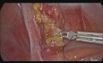 Apendicectomía laparoscópica debido a una apendicitis aguda de etiología parasitaria