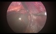 Cirugía laparoscópica retroperitoneal para cistectomía suprarrenal