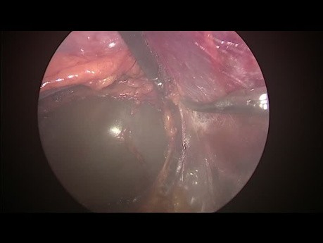 Cirugía laparoscópica retroperitoneal para cistectomía suprarrenal