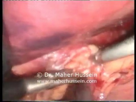 Reparación de hernia de hiato encarcelada - abordaje laparoscópico